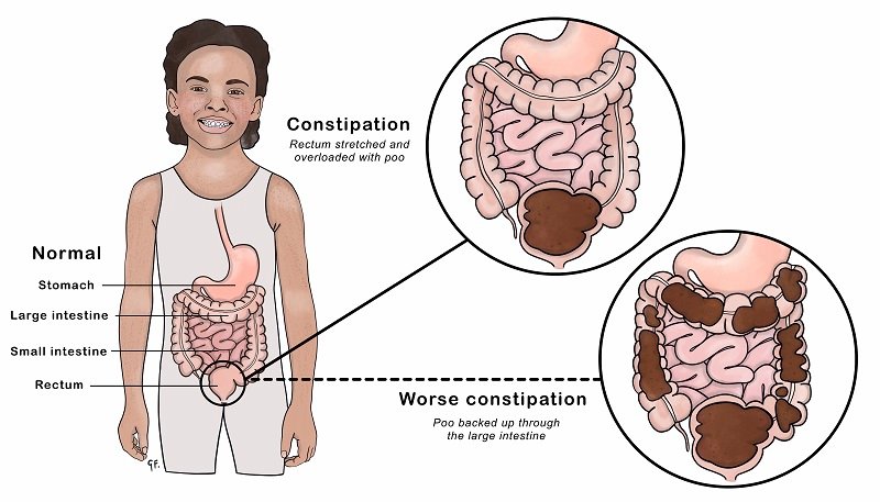Illustration of Constipation in Children