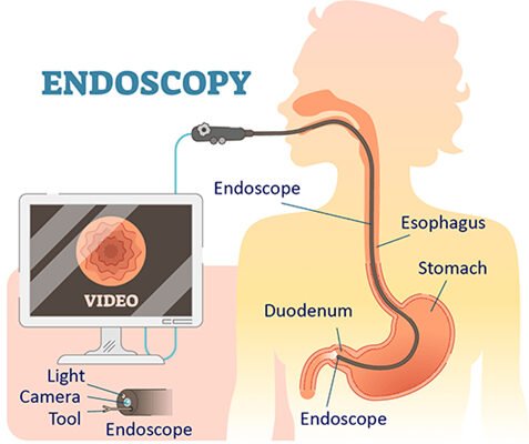 Diagram of Procedure of Gastrointestinal Endoscopy Doctor in Indore