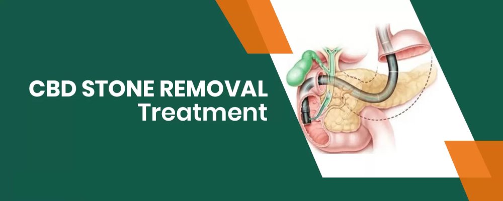 Illustration of CBD Stone Removal Treatment