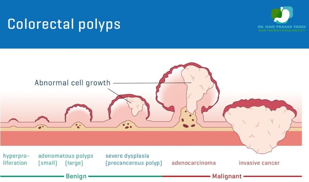 Diagram of Colorectal Polyps
