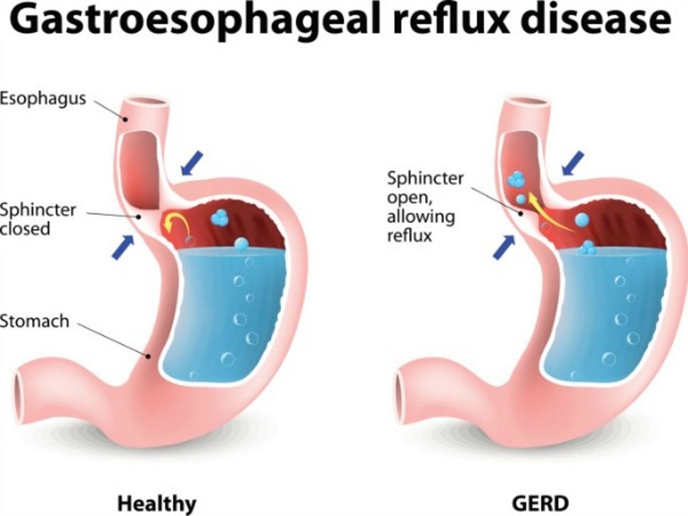 Diagram of Gastroesophageal Reflux Disease (GERD)