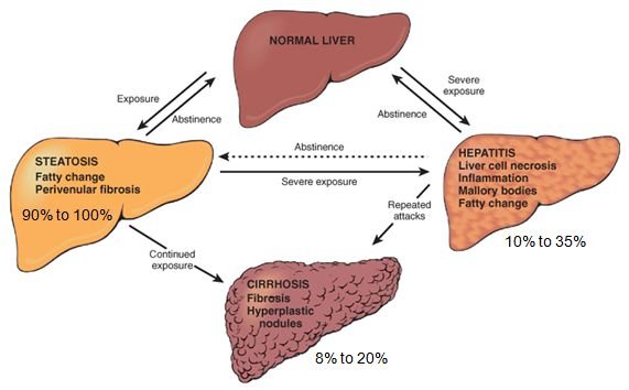 Diagram of Liver Disease Progression