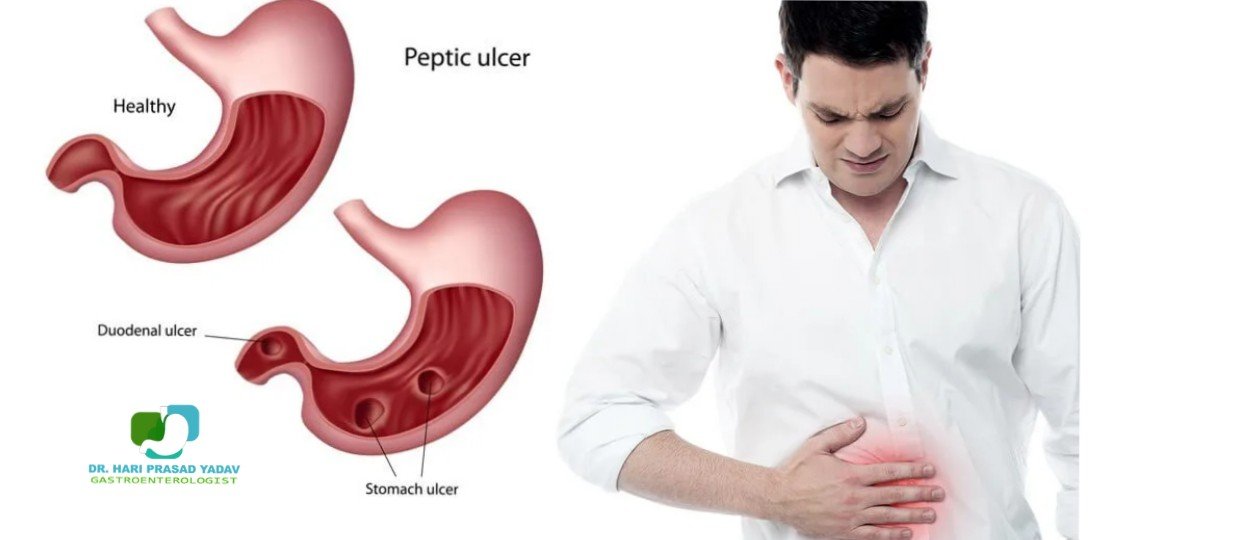 Illustration showing a healthy stomach and peptic ulcers, with a man experiencing stomach pain
